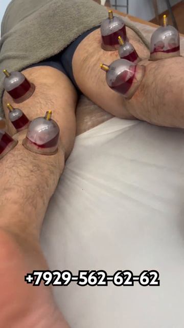 Хиджама на ноги | хиджама в Москве | массаж фитобочка смотреть онлайн