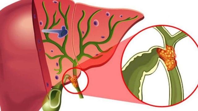 ПОВЫШЕННОМ БИЛИРУБИНЕ ЧТО МОЖНО И НЕЛЬЗЯ ЕСТЬ #Билиру?