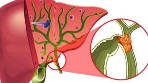 ПОВЫШЕННОМ БИЛИРУБИНЕ ЧТО МОЖНО И НЕЛЬЗЯ ЕСТЬ #Билиру?