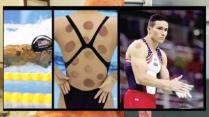 Вакуумные банки польза или вред?