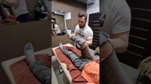 Реабилитация после перелома бедренной кости.