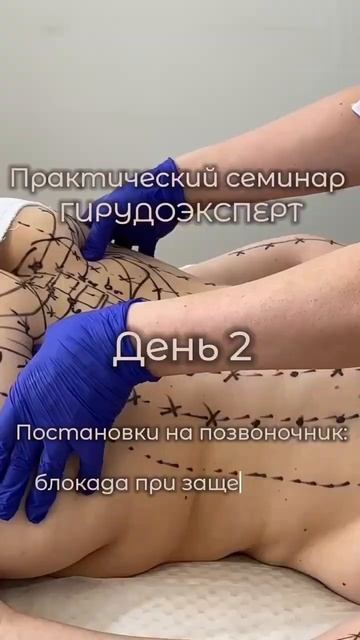 Постановки на позвоночник:блокада при защемлении гру? смотреть онлайн