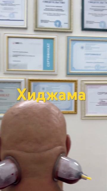 Хиджама при головной боли #правка #доктор #chiropractor смотреть онлайн