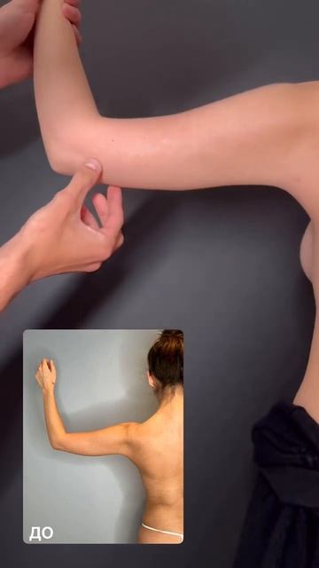 🔥Липосакция рук и плеч: результат до/после #доктор #л? смотреть онлайн