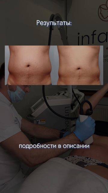 Процедура для уменьшения жировых отложений, которая р смотреть онлайн