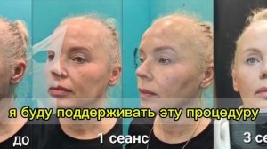 Отзыв о безоперационной подтяжке лица БМС Назарова.  Р