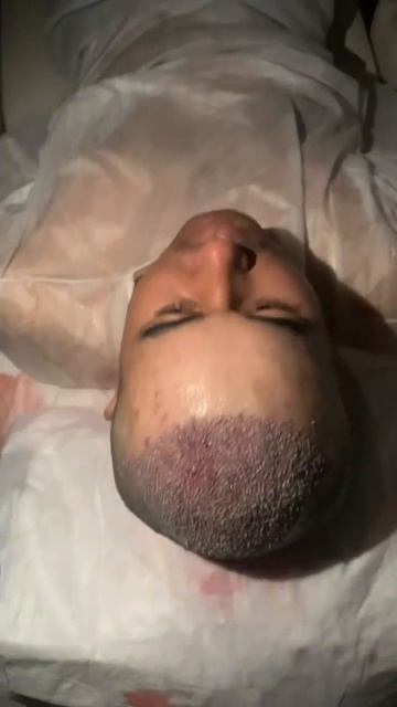 Пересадка волос после операции✅ #shorts