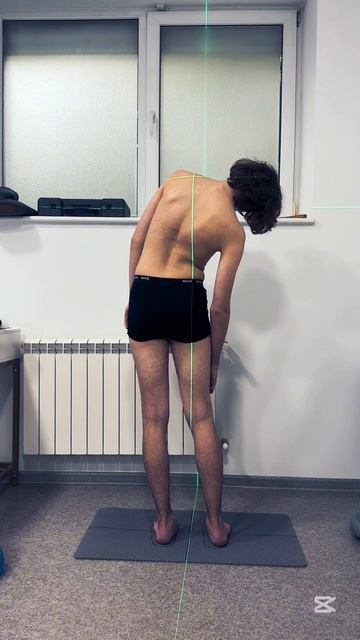 сколиоз смотреть онлайн