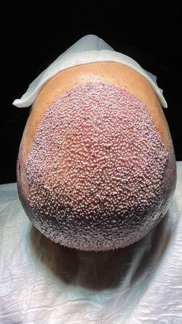 Результат спустя 1 месяц. Пересадка волос. #стамбул #ту?