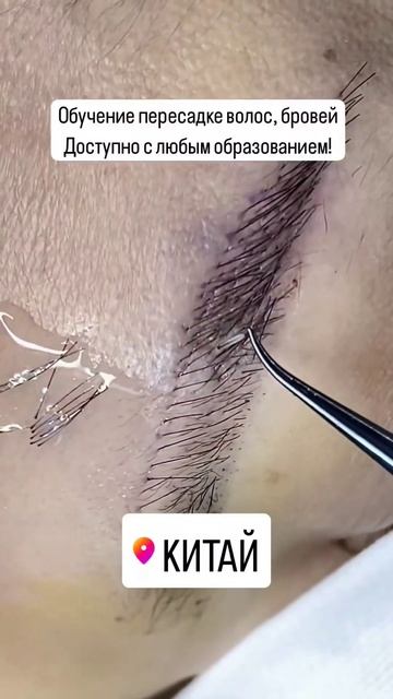 Академия 21 обучение пересадке волос, обучение пересад