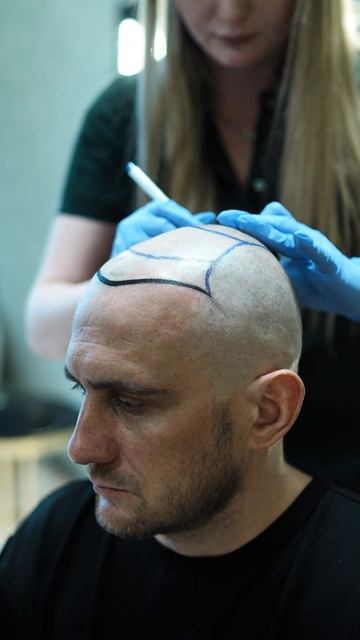 ✨ Лучший центр трансплантации волос в Алматы ✨ #краси