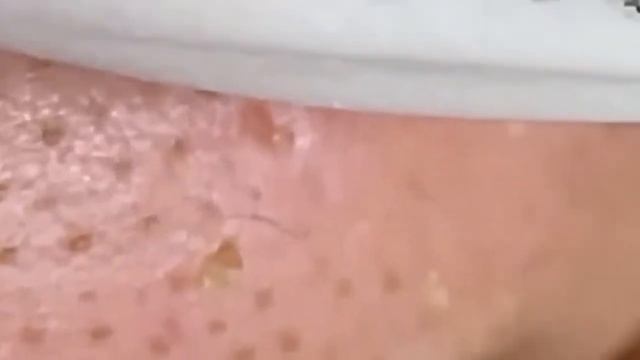 Прыщи / Огромные прыщи / Релакс с акне / Выдавливание пр