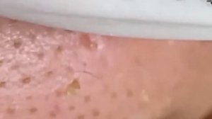 Прыщи / Огромные прыщи / Релакс с акне / Выдавливание пр