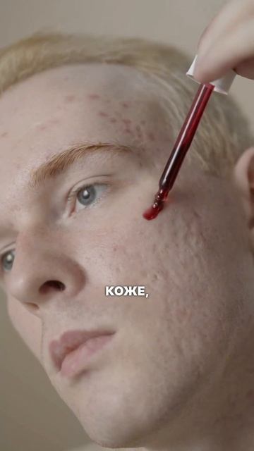 Что делать с подкожными воспалениями? Подкожные прыщи смотреть онлайн