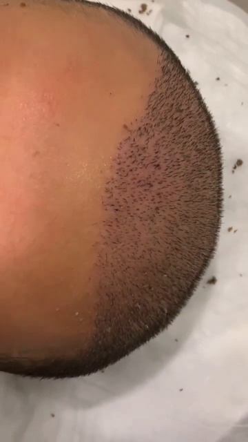 Результат пересадки волос #пересадкаволос #shorts