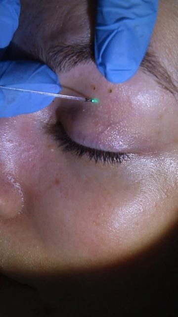 Процесс удаления миллиумов на веках смотреть онлайн