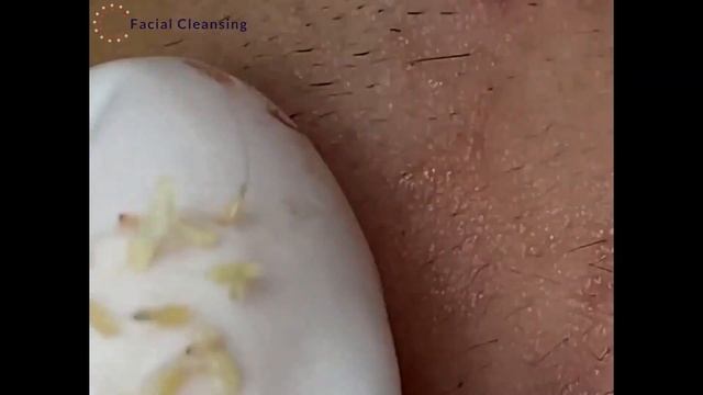 #5 Blackhead Removal \ Удаление черных точек смотреть онлайн