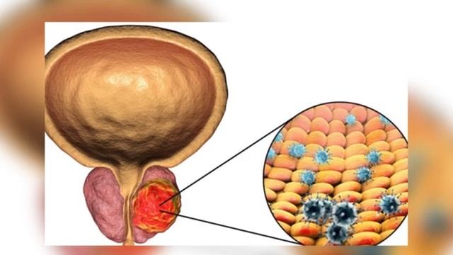 ОПАСНЫЕ СИМПТОМЫ РАК ПРОСТАТЫ, которые НЕЛЬЗЯ ИГНОРИР