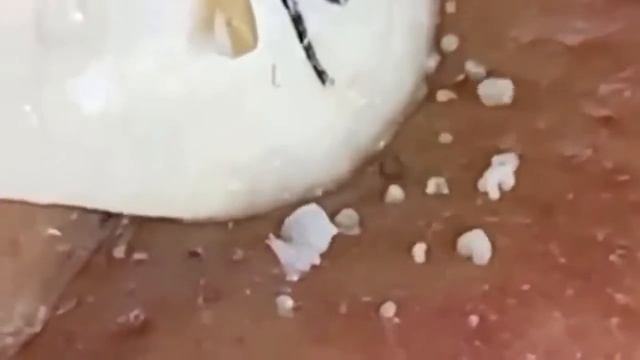 Прыщи / Огромные прыщи / Релакс с акне / Выдавливание пр