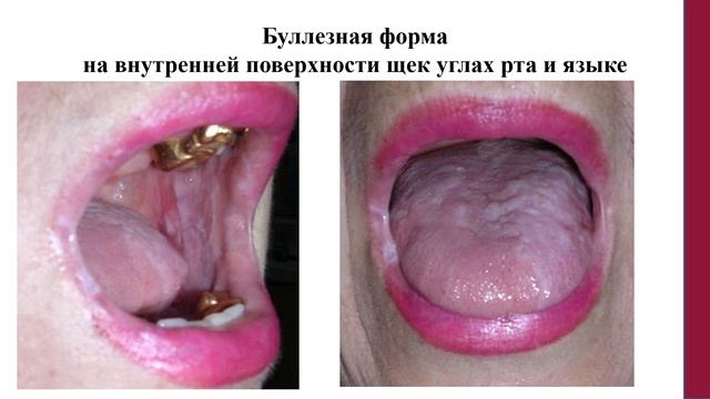 Лекция 1. Заболевания слизистой оболочки полости рта Ч смотреть онлайн
