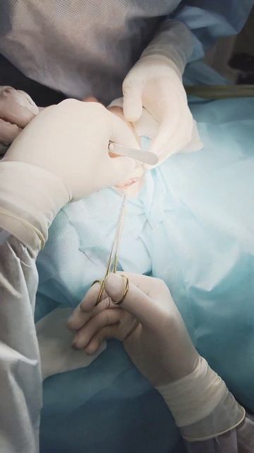 Использование ушного хряща при реконструктивной ринопластики.