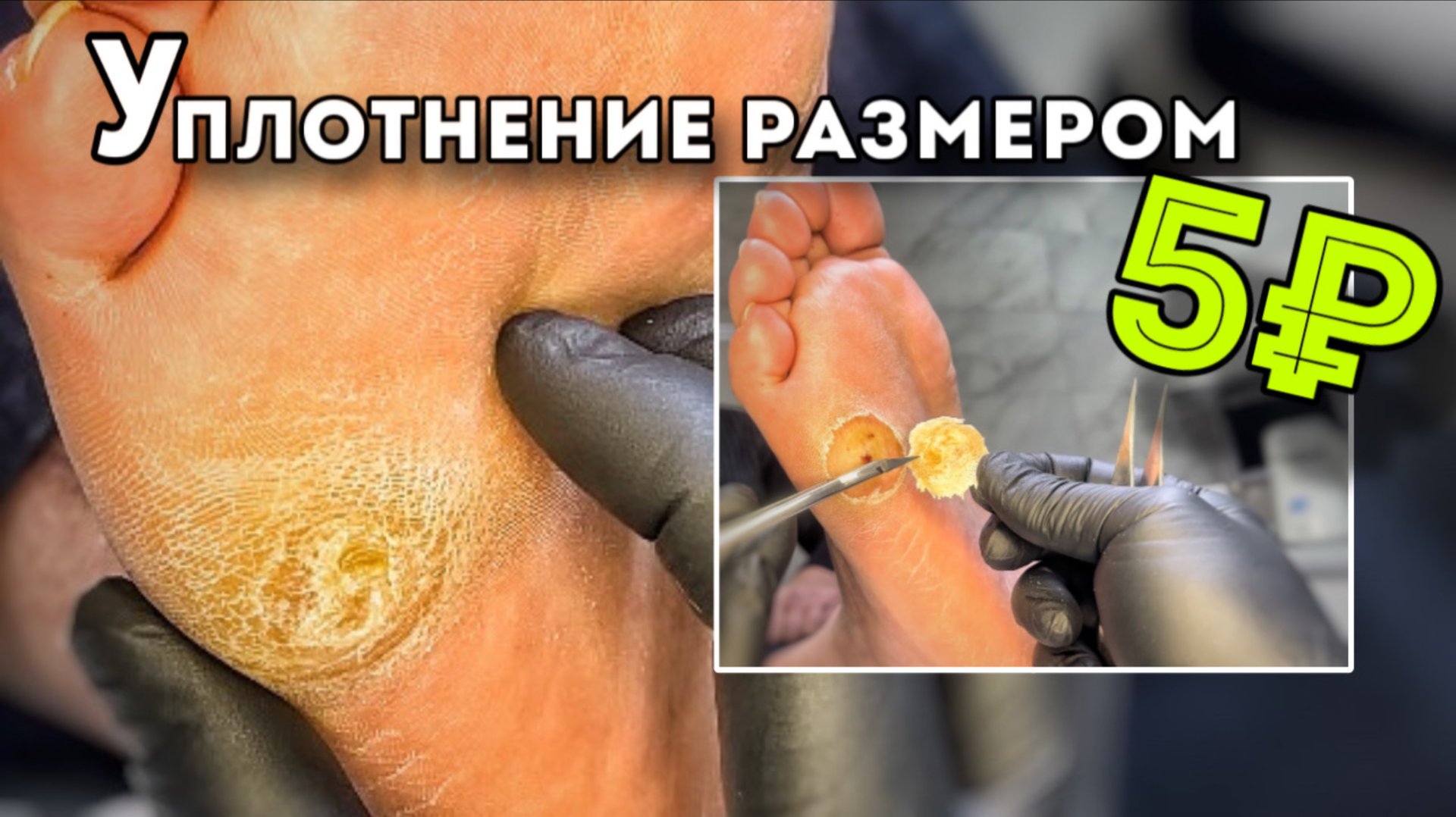 Внушающий размер мозоли которую боялись все. Специально приехал из другого города смотреть онлайн