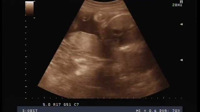 Узи 28-29 недель