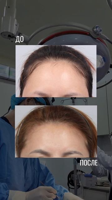 Уменьшение лба в Корее | 365 PLASTIC SURGERY KOREA #shorts #уменьшение смотреть онлайн