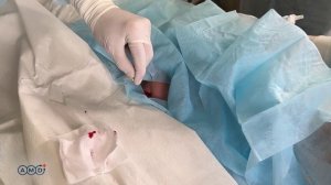 Проведение чрескожной дилатационной трахеостомии по методу Сигли набором DEAS. Установка на пациента