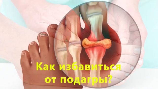 ПОДАГРА? Её НЕ будет! Причины подагры и её лечение! смотреть онлайн