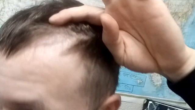 Отчёт через 4 месяца после пересадки волос в Чебоксара смотреть онлайн