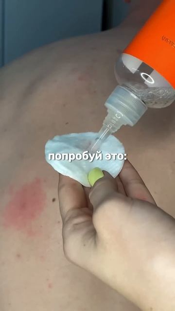 КАК УБРАТЬ ПРЫЩИ НА СПИНЕ смотреть онлайн