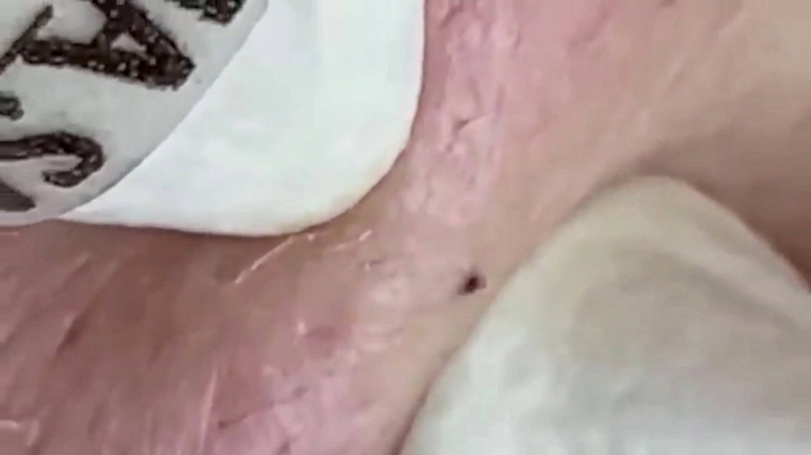 Симпатичные прыщи убрали мы сегодня