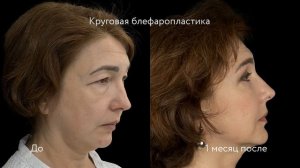 Круговая блефаропластика До и После: пластика верхних