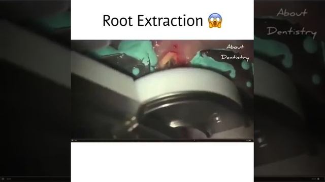 Шок! Новый способ удаление зубов 🇷🇺 Shock! A new way to remove teeth🇺🇸 смотреть онлайн