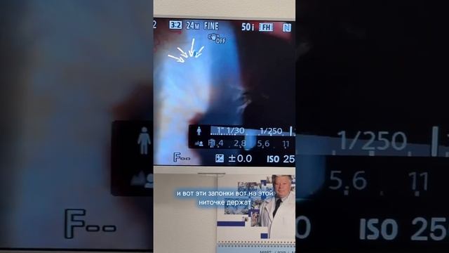 Смещение (дислокация) хрусталика. Лечение. #зрение #иол #смещениеиол смотреть онлайн