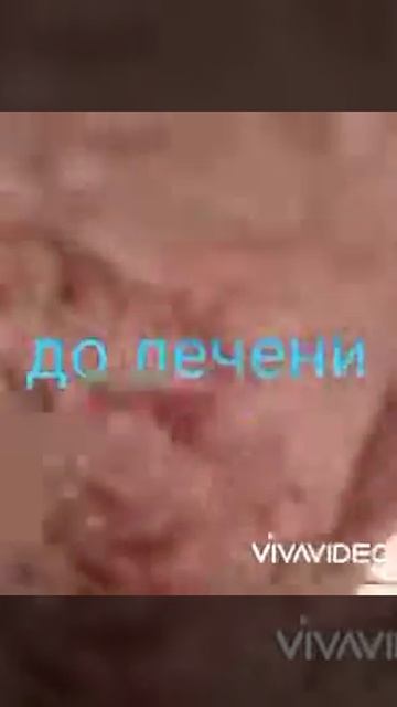 ШОК контент/ Псориаз излечим!!! Алоэ вера / Отзыв LR смотреть онлайн