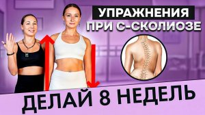УПРАЖНЕНИЯ ПРИ СКОЛИОЗЕ