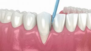 Рецессия десны операция по пересадке мягких тканей