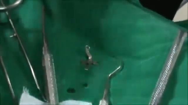 Операция по установке якорной небной пластины PM 01 01 или PM 01 02