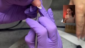 РЕБРИСТЫЕ НОГТИ (продольные борозды на ногтях)