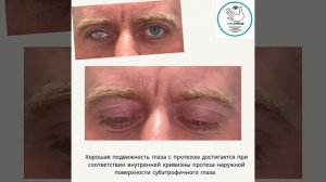 Протез на субатрофичном глазе