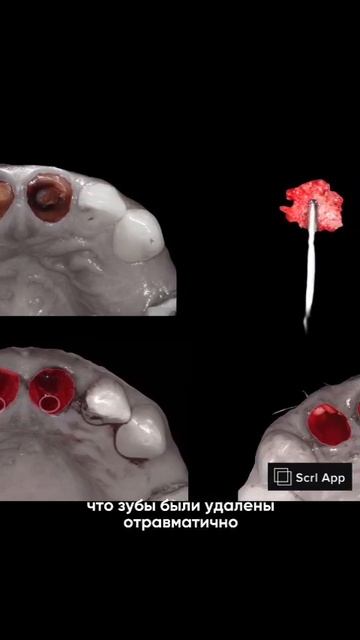 Кейс Одномоментная имплантация.  хирург имплантолог Амир Рустемович. 87019077744