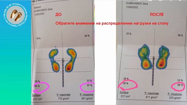 Отзыв о стельках Health Priority  Зара  Франция о стельках При