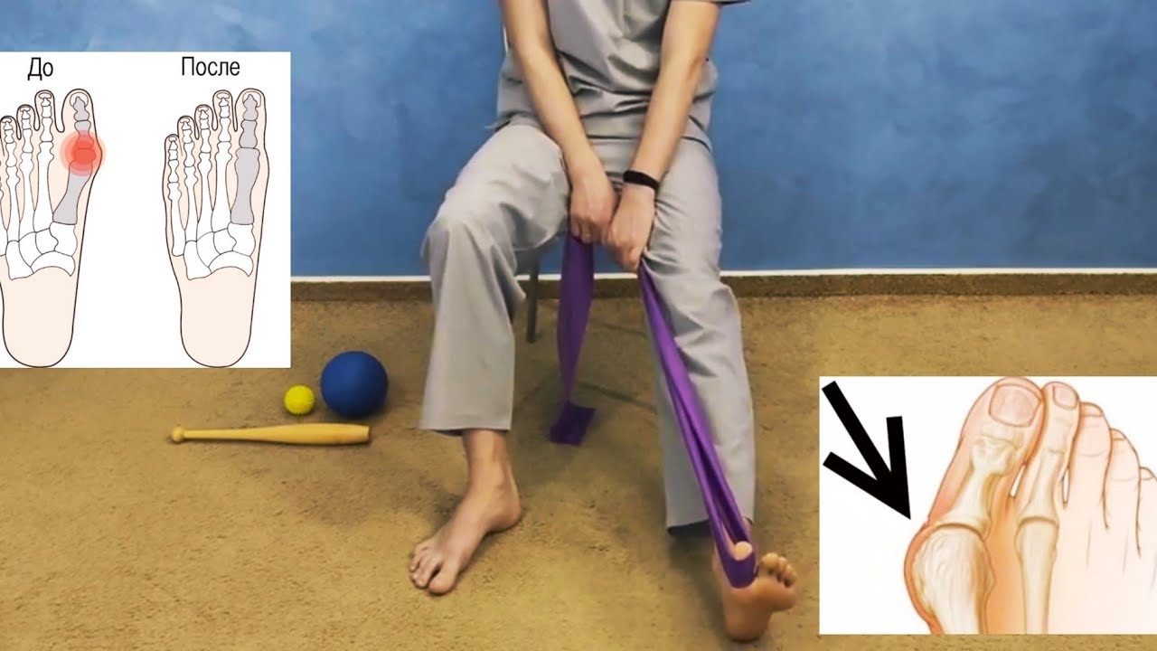 Гимнастика при вальгусной деформации стопы - После операции смотреть онлайн