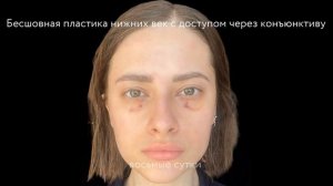 Трансконъюнктивальная блефаропластика: реабилитация