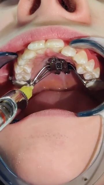 #стоматологалматы #брекетыалматы #ортодонталматы #элайнерыалматы