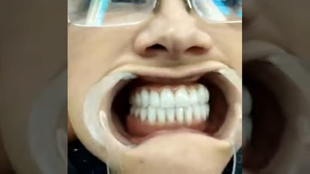 All On 4 / All On Four - все зубы на 4 имплантах за 1 день. Неватекс отзывы пациентов