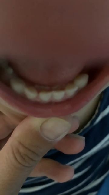У ребёнка 2 ой ряд зубов 🤪😇🤪