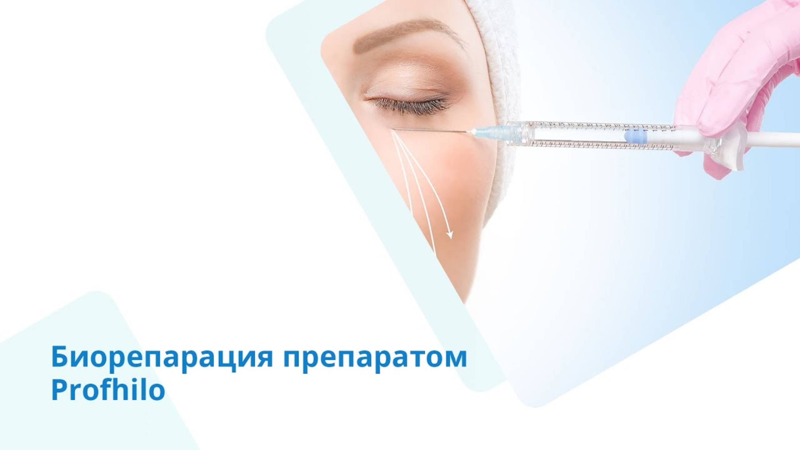 Биорепарация препаратом Profhilo (Профайло) смотреть онлайн
